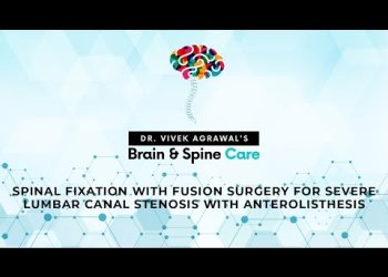 SPINAL FIXATION WITH FUSION SURGERY FOR SEVERE LUMBAR CANAL STENOSIS WITH ANTEROLISTHESIS